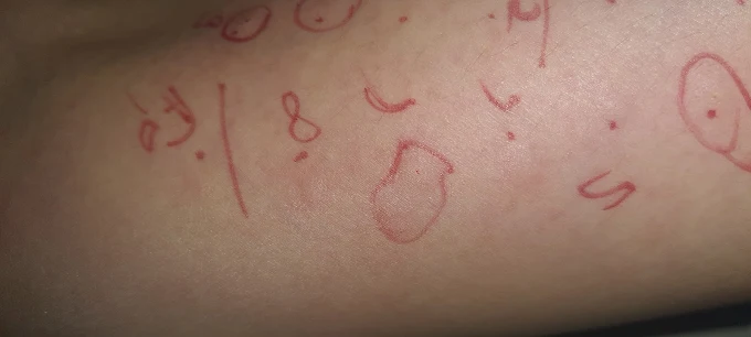 Allergy, Asthma(एलर्जी, अस्थमा)