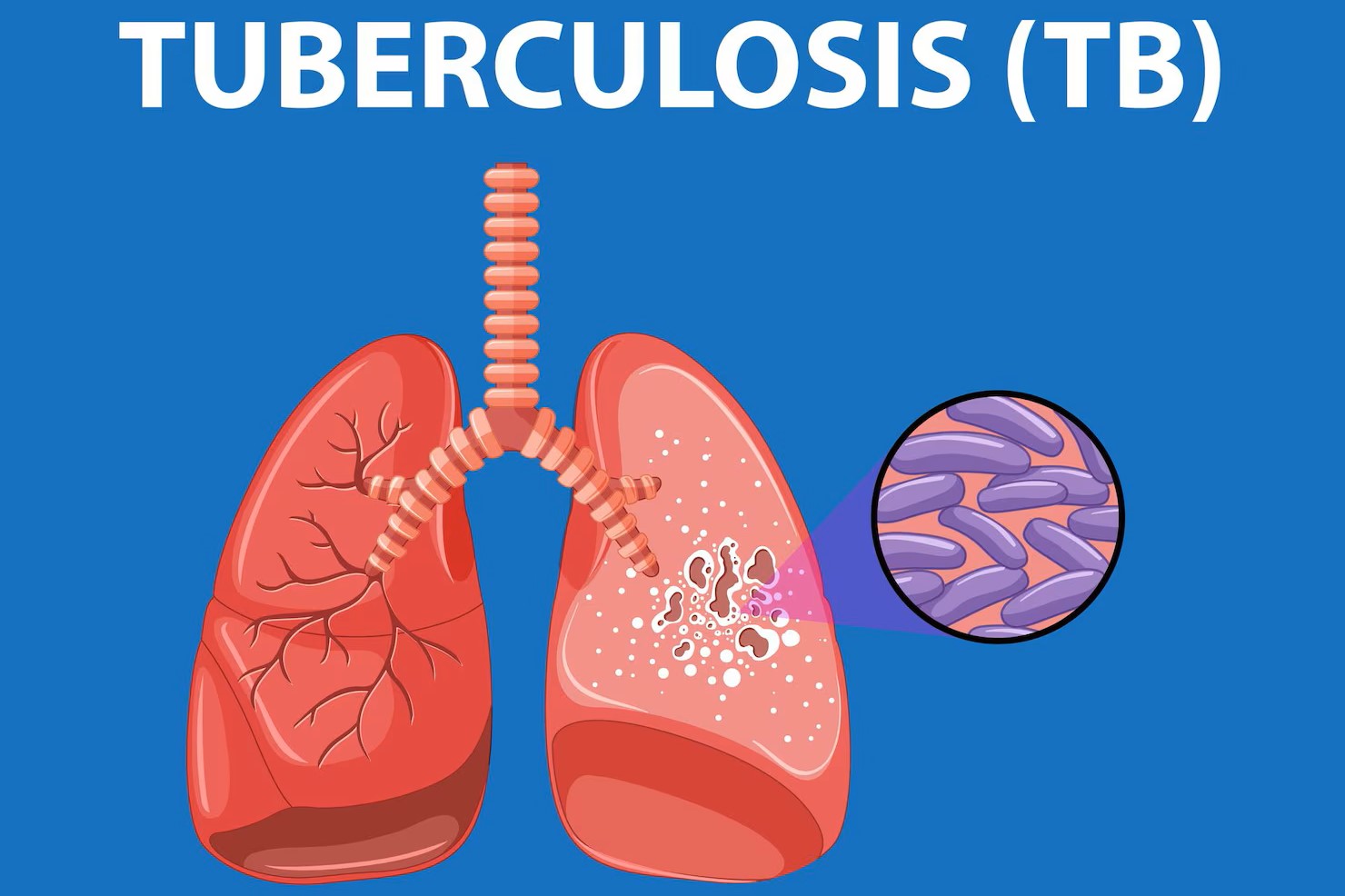 Pneumonia & Tuberculosis (न्यूमोनिया एवं टीबी)
